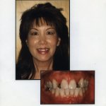 Image of a smiling patient with a close up image of teeth