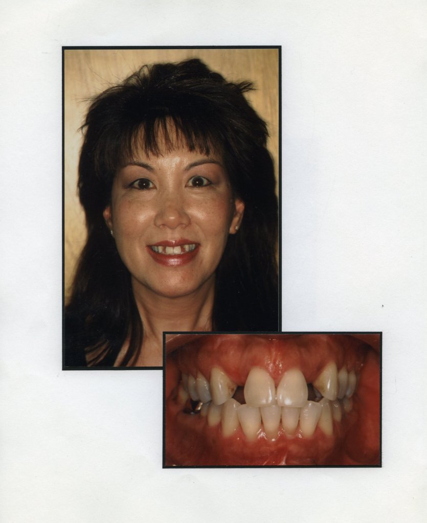 Image of a smiling patient with a close up image of teeth
