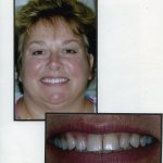 Image of a smiling patient with a close up image of teeth