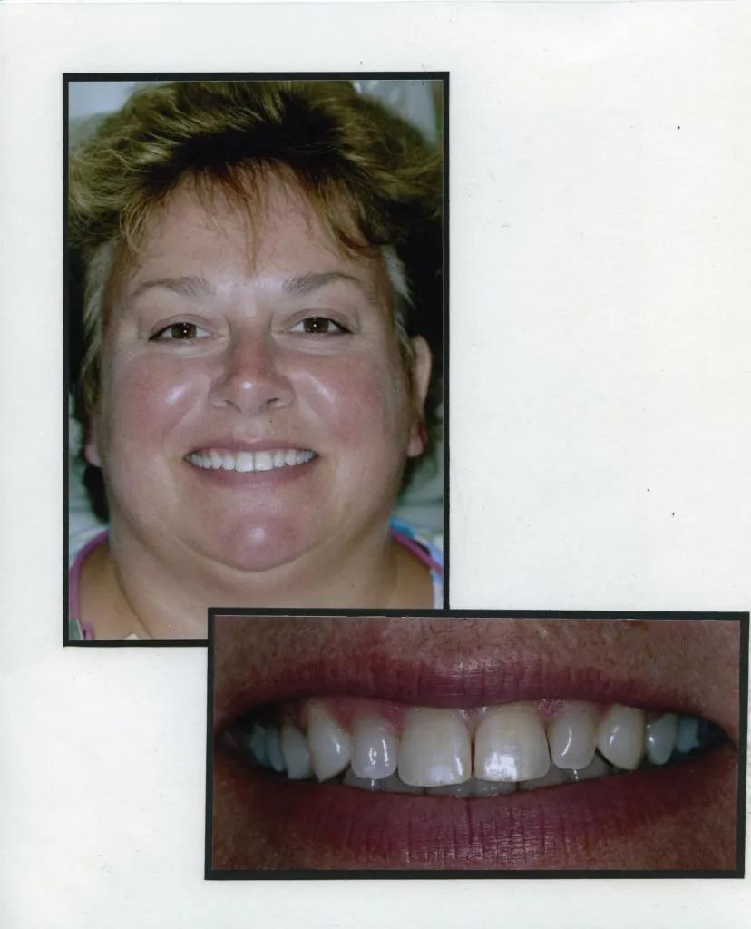 Image of a smiling patient with a close up image of teeth