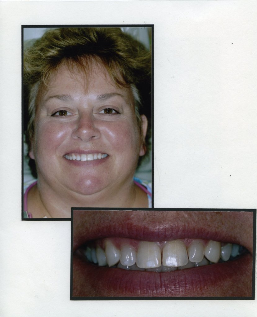 Image of a smiling patient with a close up image of teeth