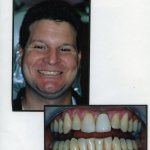 Image of a smiling patient with a close up image of teeth