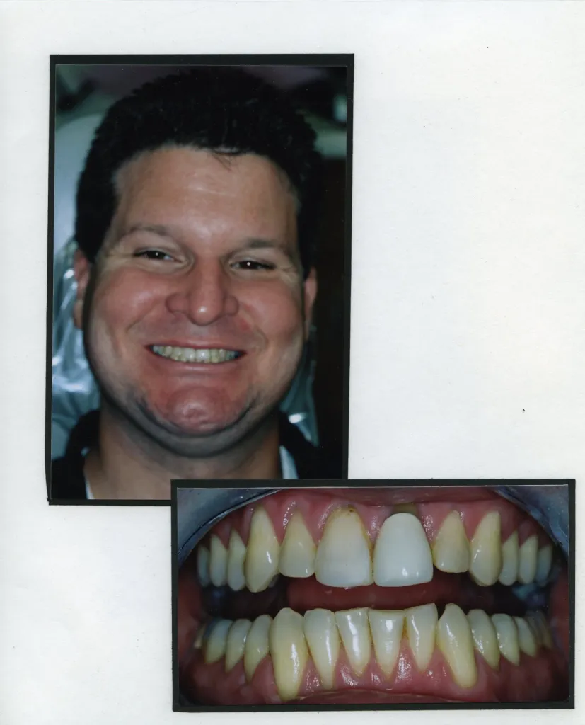 Image of a smiling patient with a close up image of teeth