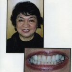 Image of a smiling patient with a close up image of teeth