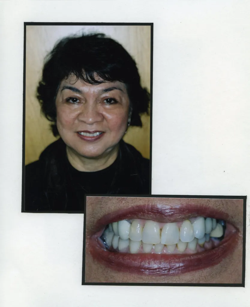 Image of a smiling patient with a close up image of teeth