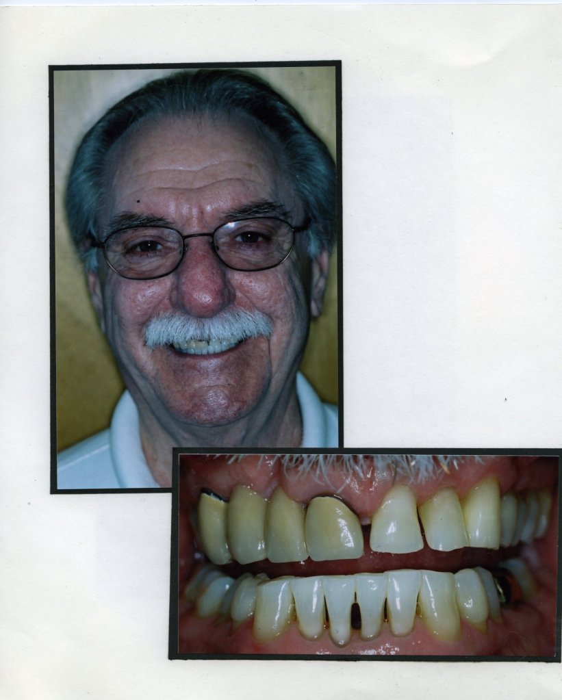 Image of a smiling patient with a close up image of teeth