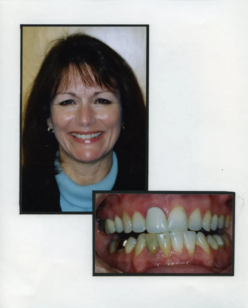 Image of a smiling patient with a close up image of teeth