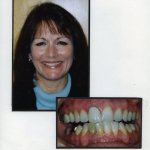 Image of a smiling patient with a close up image of teeth