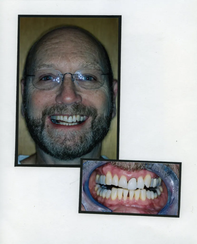 Image of a smiling patient with a close up image of teeth