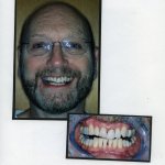 Image of a smiling patient with a close up image of teeth