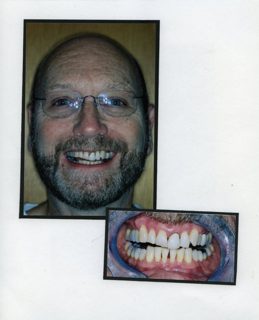 Image of a smiling patient with a close up image of teeth