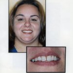 Image of a smiling patient with a close up image of teeth