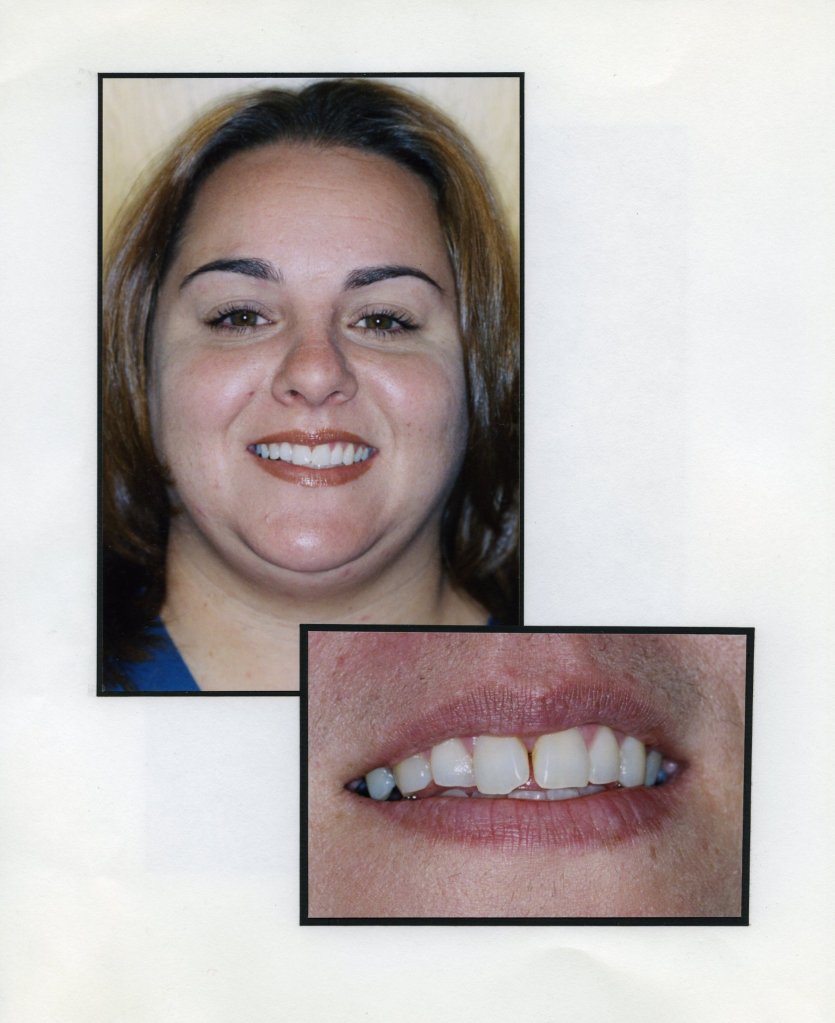 Image of a smiling patient with a close up image of teeth