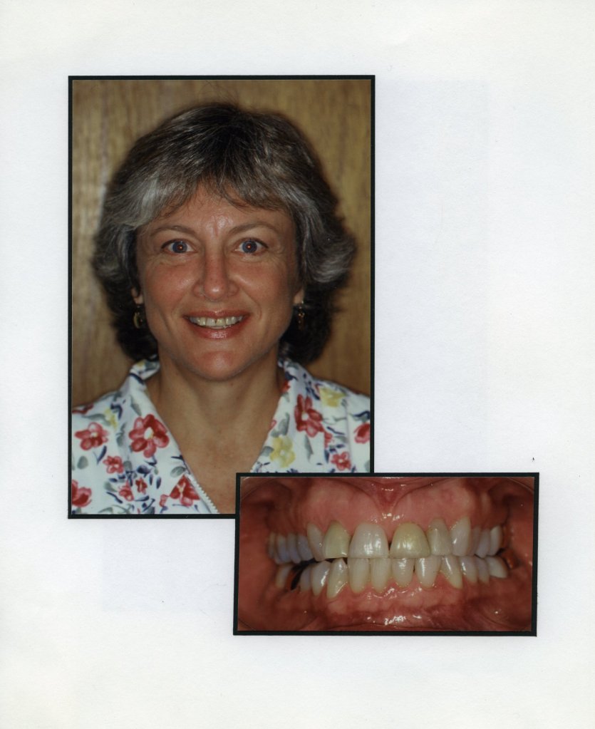 Image of a smiling patient with a close up image of teeth