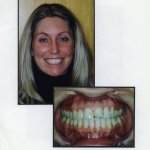 Image of a smiling patient with a close up image of teeth