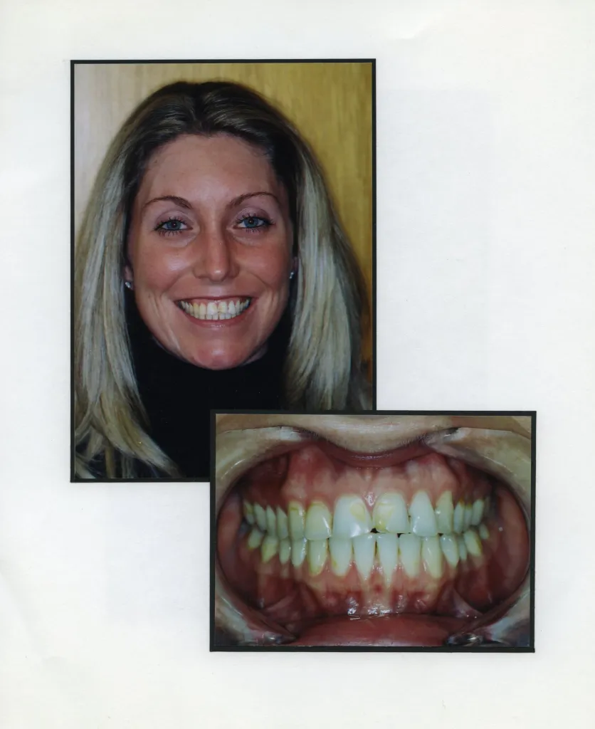 Image of a smiling patient with a close up image of teeth
