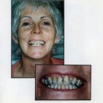 Image of a smiling patient with a close up image of teeth