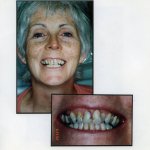 Image of a smiling patient with a close up image of teeth