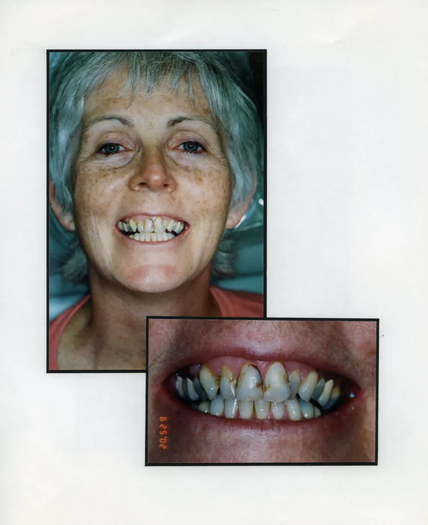 Image of a smiling patient with a close up image of teeth