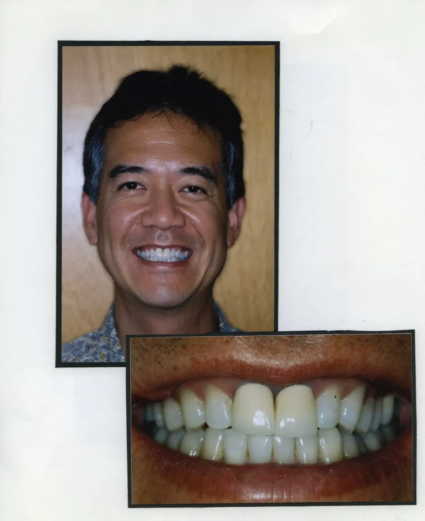 Image of a smiling patient with a close up image of teeth