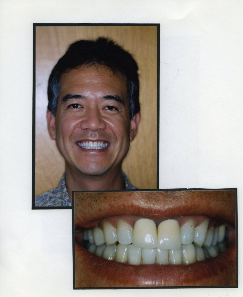 Image of a smiling patient with a close up image of teeth