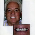 Image of a smiling patient with a close up image of teeth
