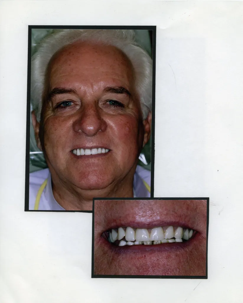 Image of a smiling patient with a close up image of teeth