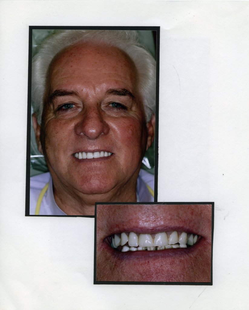 Image of a smiling patient with a close up image of teeth