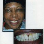 Image of a smiling patient with a close up image of teeth
