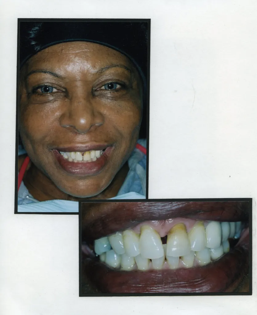 Image of a smiling patient with a close up image of teeth