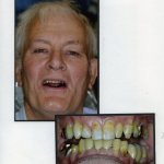 Image of a smiling patient with a close up image of teeth