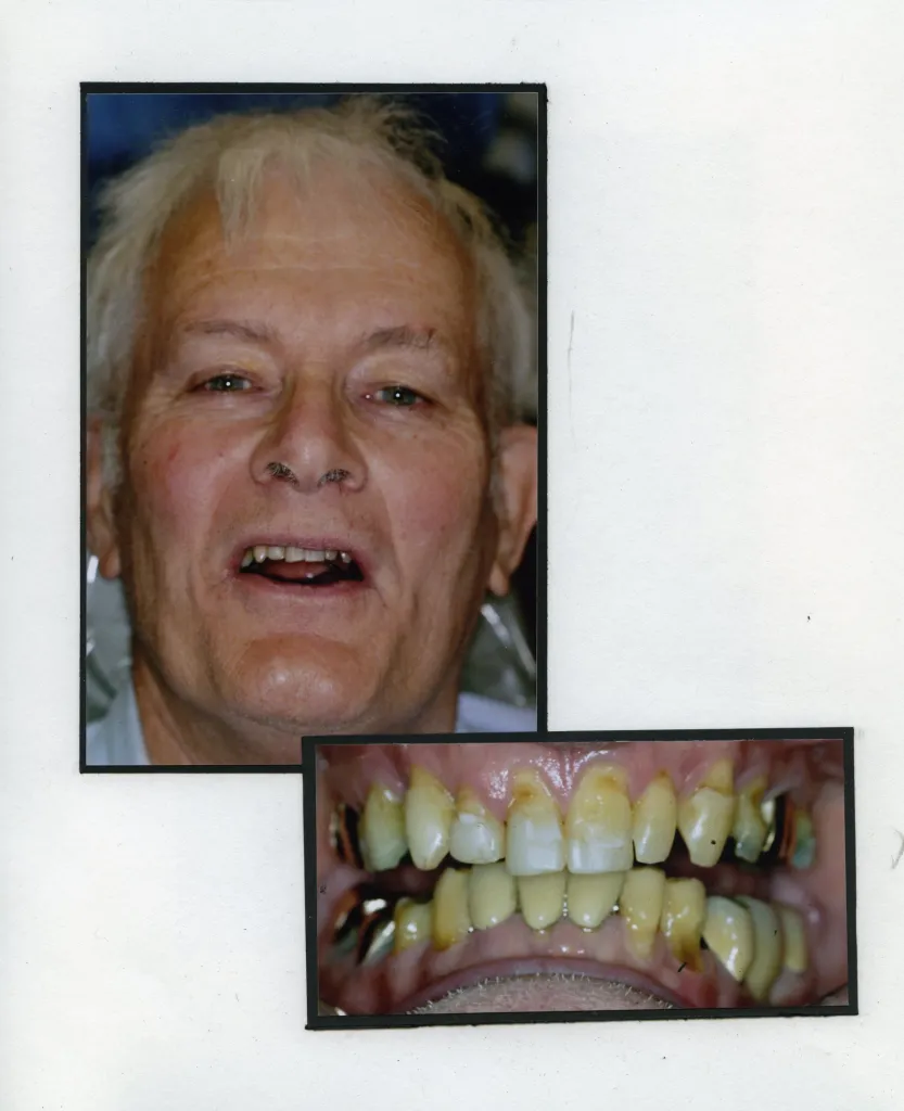 Image of a smiling patient with a close up image of teeth