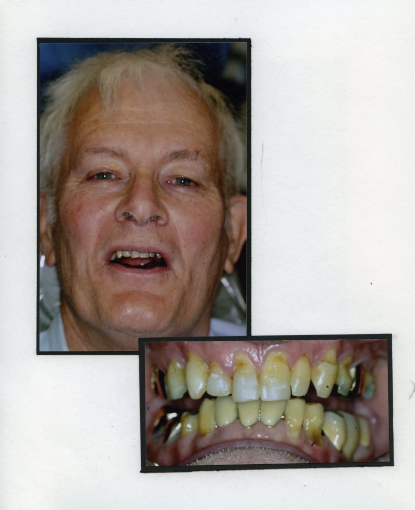Image of a smiling patient with a close up image of teeth